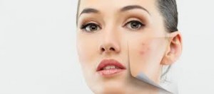 ACNE (4)